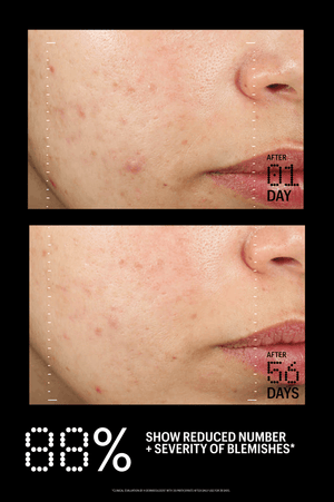 Azelaic & Kojic Advanced Clarifying Serum